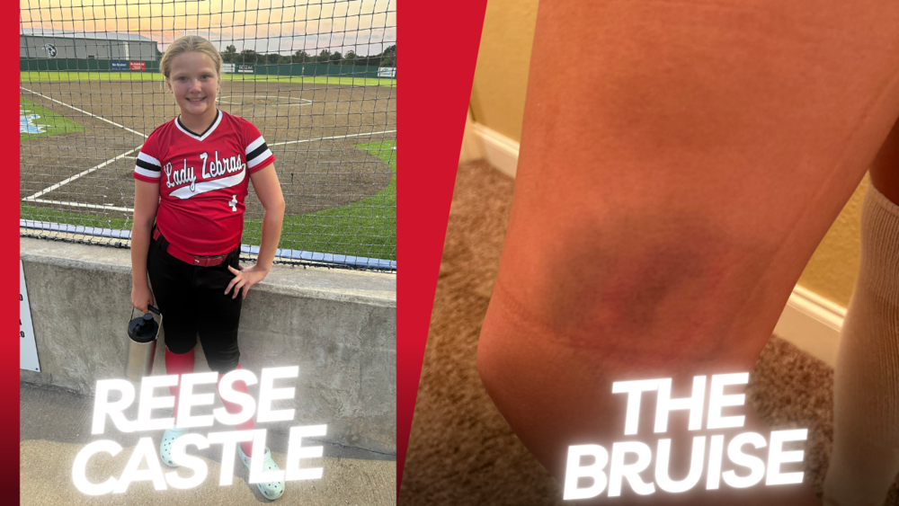 Reese and her bruise